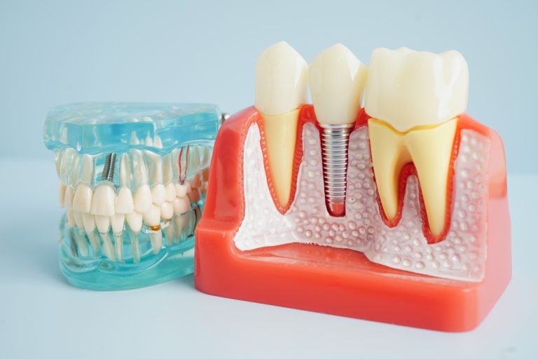 The Advantages of Dental Implants for Tooth Replacements