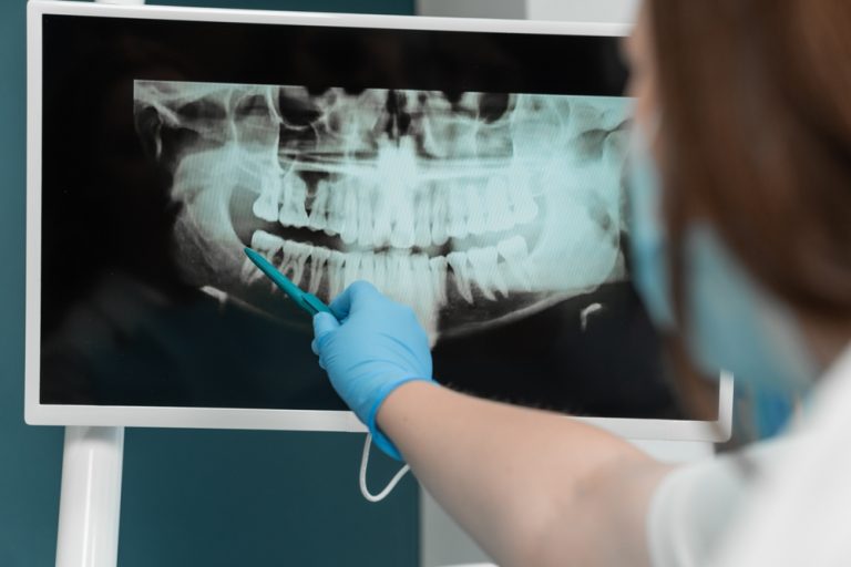 Advancements in Digital X-Ray Technology: A New Era in Dental Care