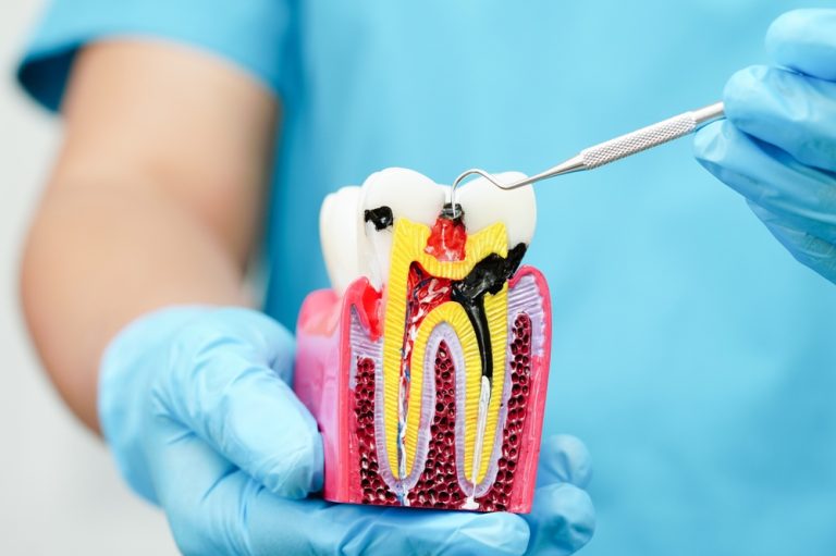 The Facts About Root Canals