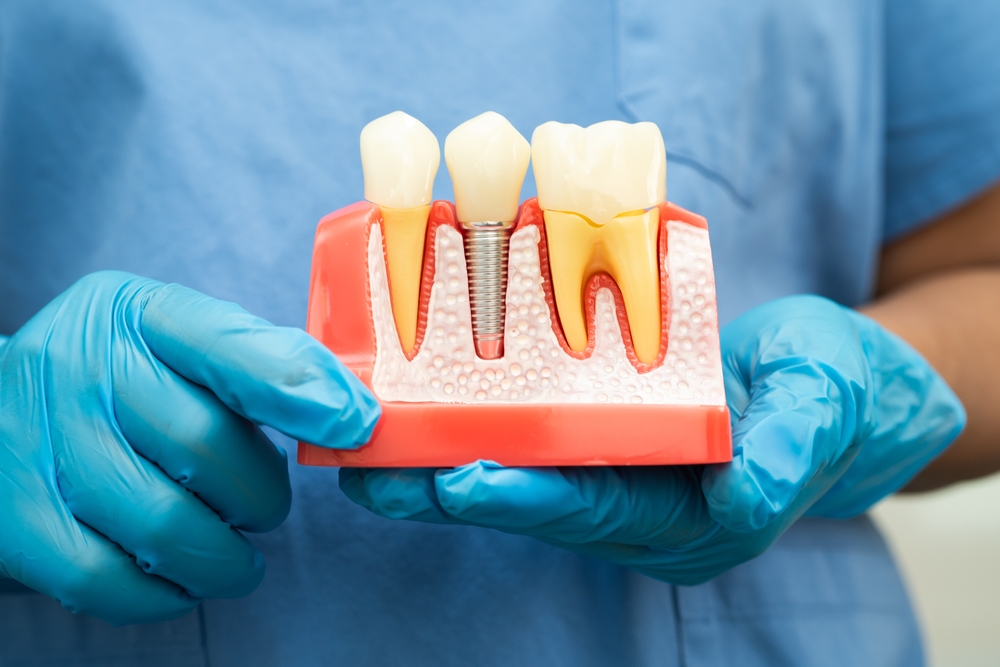 The Process of Getting a Dental Crown