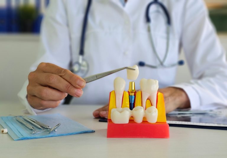 Signs You May Need a Dental Crown