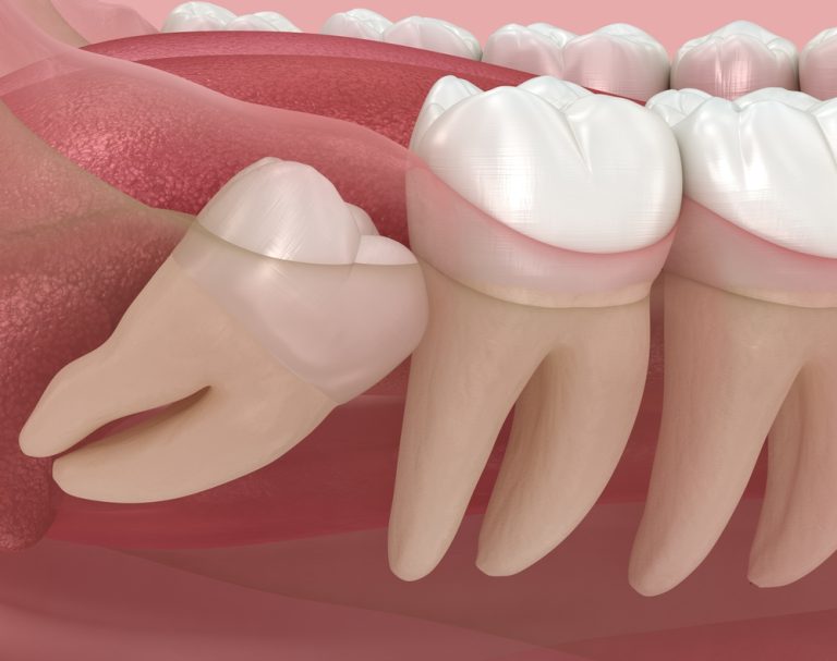 What To Know About Wisdom Tooth Extractions