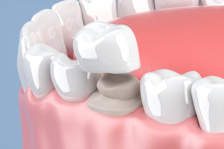 3d render of jaw with teeth and dental crown restoration