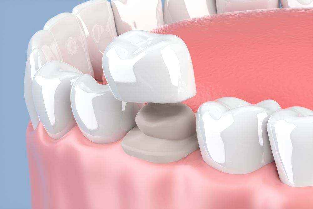 3d render of jaw with teeth and dental crown restoration