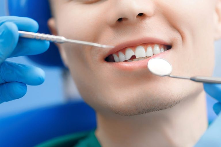 Closeup man smile mouth with broken tooth at reception at dentist, concept of healthy smile.