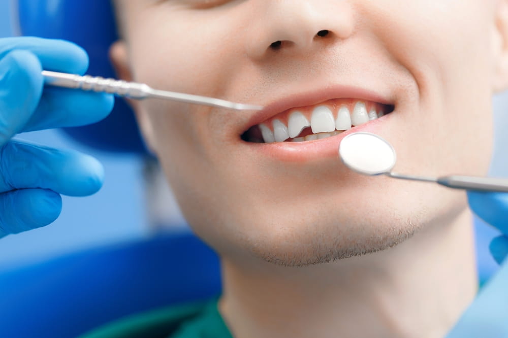 Closeup man smile mouth with broken tooth at reception at dentist, concept of healthy smile.